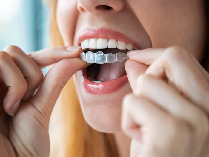 Aparelhos transparentes — tratamento odontológico na Base Odontologia