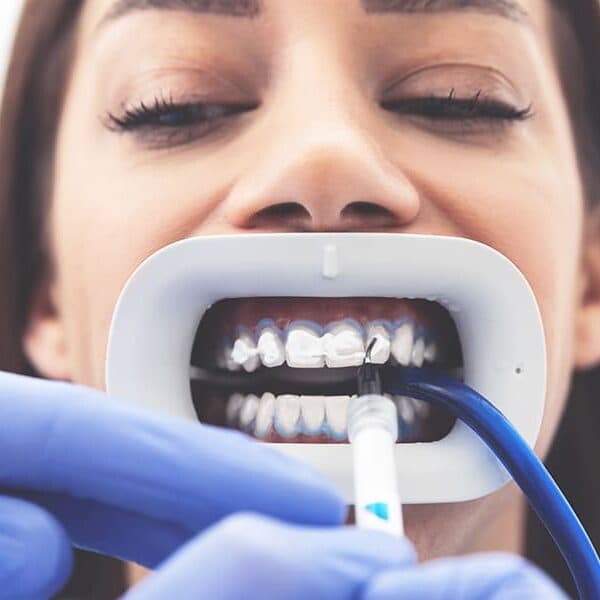 Clareamento dental — tratamento odontológico na Base Odontologia