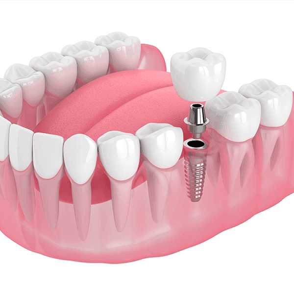 Implante dentário — tratamento odontológico na Base Odontologia