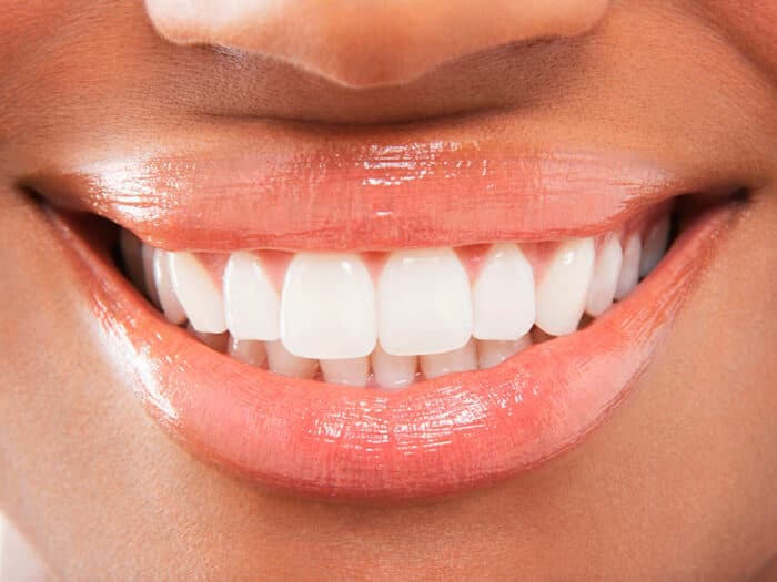 Lentes de contato dental — tratamento odontológico na Base Odontologia